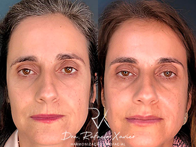 Preenchimento Full Face