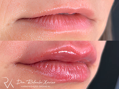 Preenchimento labial